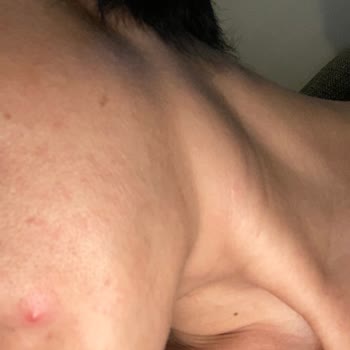 Estee Lauder Double Wear Fondöten Sivilce Yapıyor