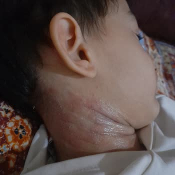 Namık Kemal Üniversitesi Hastanesi Tekirdağ'da Çocuk Alerji Randevu Sıkıntısı