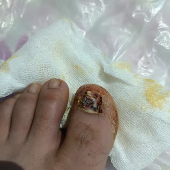 Gaziantep Üniversitesi Şahinbey Araştırma ve Uygulama Hastanesi Tırnak Operasyonu Kötü Geçti İlaç Vermesi Lazımdı Vermedi