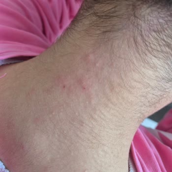 Sağlık Bakanlığı Uyuz Hastalığı Bıktık Acil Çözüm Salgın Durumda