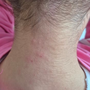 Sağlık Bakanlığı Uyuz Hastalığı Bıktık Acil Çözüm Salgın Durumda