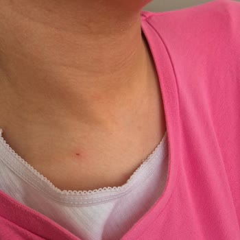 Sağlık Bakanlığı Uyuz Hastalığı Bıktık Acil Çözüm Salgın Durumda