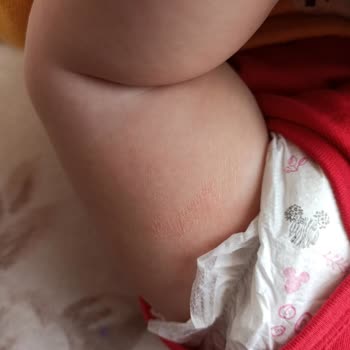 Dalin Bebek Yağı Bebeğime Egzama Yaptı