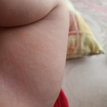 Dalin Bebek Yağı Bebeğime Egzama Yaptı