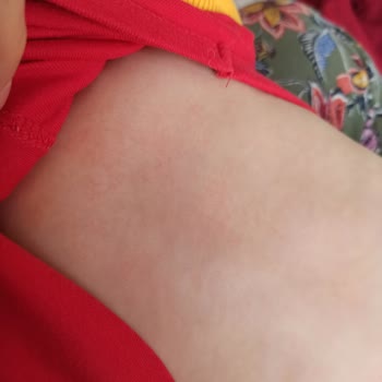 Dalin Bebek Yağı Bebeğime Egzama Yaptı