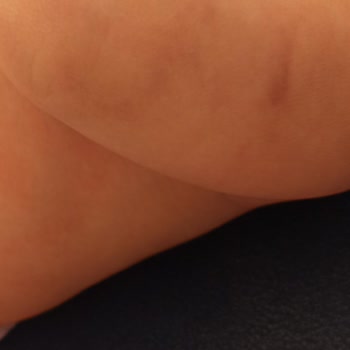 Kırşehir Eğitim ve Araştırma Hastanesi Çocuk Sağlığı Bölümünde Yaşanan Kan Alma Sorunu