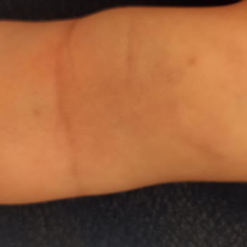 Kırşehir Eğitim ve Araştırma Hastanesi Çocuk Sağlığı Bölümünde Yaşanan Kan Alma Sorunu