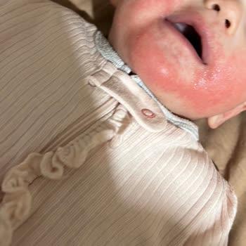 Orzax İlaç Ocean Demir Damlası Egzama Ve Kızarıklık!