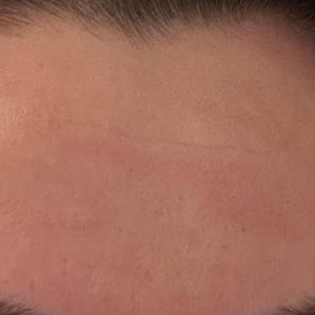 Institut Esthederm Cildim Kıpkırmızı: Esthederm Krem Tepkisi