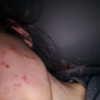 The Purest Solutions Cildimde Sivilce Sorunu