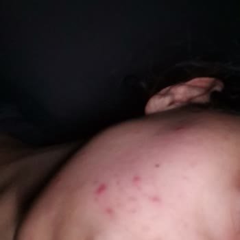 The Purest Solutions Cildimde Sivilce Sorunu