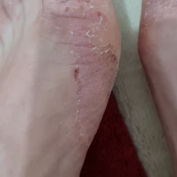 Trendyol Ayakkabı Derisinde Et Yiyen Bakteri Var Sandım Çok Korktum.