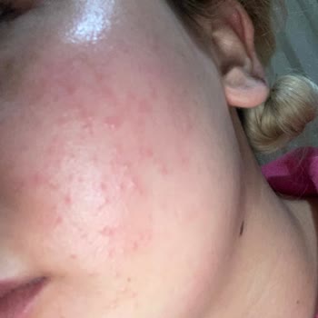 Braun Kişisel Bakım Ürünleri Braun Ürünleri Pişmanlık Yüzüm Mahvoldu