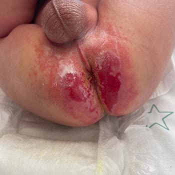 Goon Bebek Bezi Bebek Bakım Ürününden Kaynaklanan Rahatsızlık