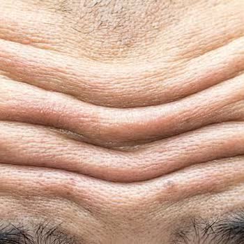 Evamed Clinic Botoks Sonrası Beklentim Karşılanmadı