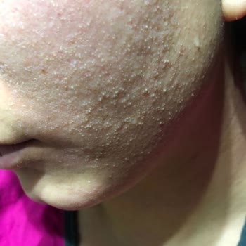 Lilium Güzellik Merkezi Dermapen Sonrası Yüzümün Hali