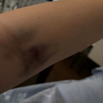 Yaşar Hastanesi Damarımı Patlattı