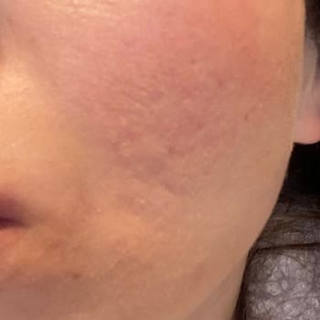 Yves Rocher Sivilce Bile Çıkmayan Yüzümü Egzama Gibi Yaptı!