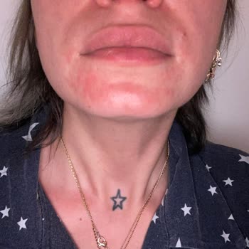 Loreal Parisin Ürünleri Alerji Yaptı