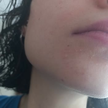 Bioderma Atoderm Creme Ultra Cildimde Tahrişe Ve Sivilceye Neden Oldu