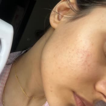 Yves Rocher Komedon Sivilce Yaptı