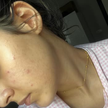 Yves Rocher Komedon Sivilce Yaptı