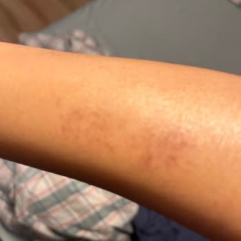 Fizyomer Lazer Epilasyon Yanığı