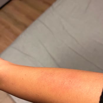 Fizyomer Lazer Epilasyon Yanığı