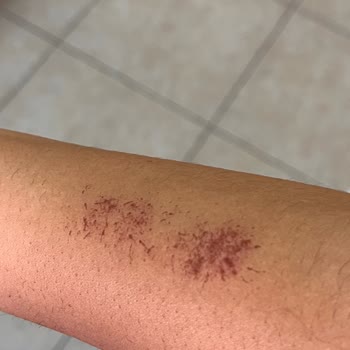 Fizyomer Lazer Epilasyon Yanığı