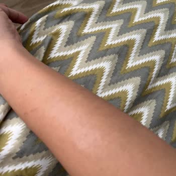 Fizyomer Lazer Epilasyon Yanığı