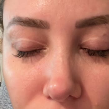 Özel Çankaya Tıp Merkezi (İzmir) Göz Kapak Faciası