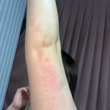 Aris Güzellik Merkezleri Vücudumu Yaktı  Ve Tüyler Hiç Bitmedi