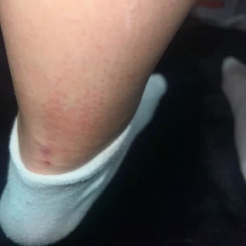 Aris Güzellik Merkezleri Vücudumu Yaktı  Ve Tüyler Hiç Bitmedi