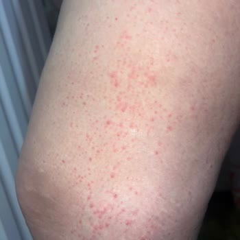 Aris Güzellik Merkezleri Vücudumu Yaktı  Ve Tüyler Hiç Bitmedi