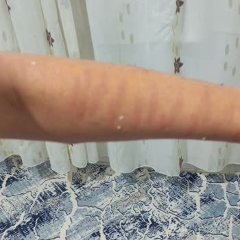 BİM Kiwi'nin Lazer Aleti Her Yerimi Yaktı