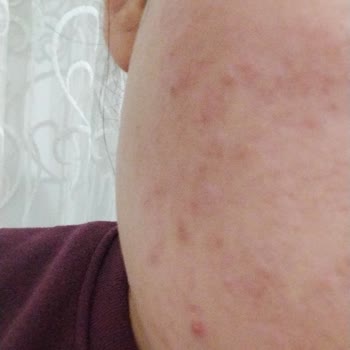 Gratis Bee Beauty Pirinç Kağıt Maske Cildimde Yanma Ve Kızarıklık Yaptı