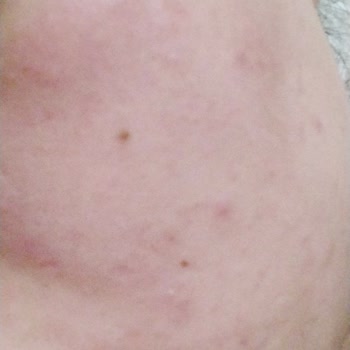 Gratis Bee Beauty Pirinç Kağıt Maske Cildimde Yanma Ve Kızarıklık Yaptı