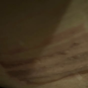 Dünyamed Güzellik Salonları Çorlu Dünyamed İkinci Derece Lazer Yanığı