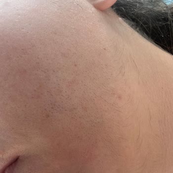 Medica Derma Dr. İstemi Damgacı Asla Yanarsınız