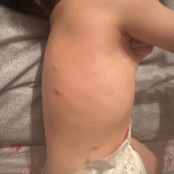 Sağlık Bakanlığı Uyuz Var Faydalı Tedavi Yok Geçmiyor?