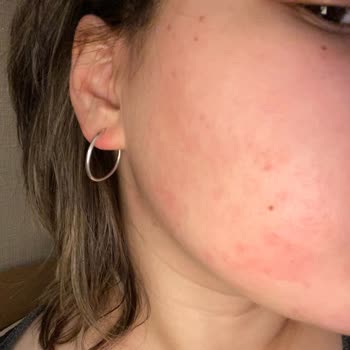 Bioderma Sebium Global Kullanımıyla Kaşıntı, Kızarıklık Ve Tahriş