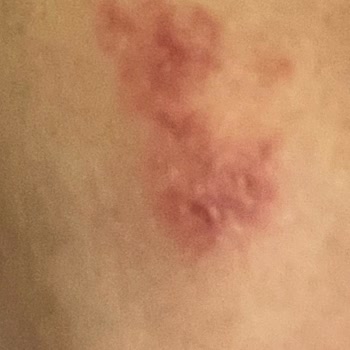 Linemed Aesthetic Dermapen Sonrası Deformasyon