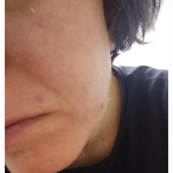 New Well Güneş Kremi Sivilce Yapıyor