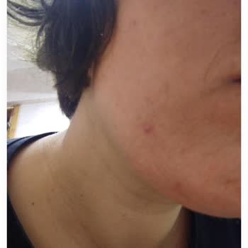 New Well Güneş Kremi Sivilce Yapıyor