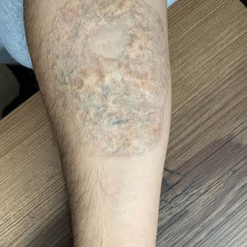 Dr. Ebru Ulu Dövme Silme İşlemi Kabusa Dönüştü