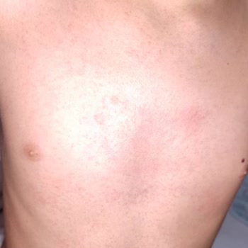 Edis Pharma İlaç Xabion Losyon Şikayeti