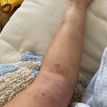 Medical Point İzmir Hastanesi Kan Alım Sonrası Kolda Şiddetli Ağrı Ve Morluk