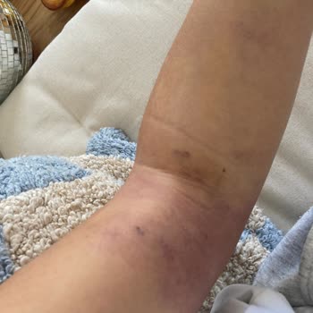 Medical Point İzmir Hastanesi Kan Alım Sonrası Kolda Şiddetli Ağrı Ve Morluk