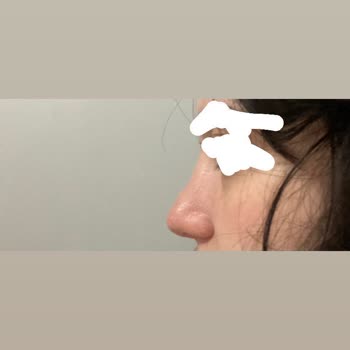 Op. Dr. Seyithan Kırtay Yapılan Estetikten Hiç Memnun Kalmadım, Yazık.