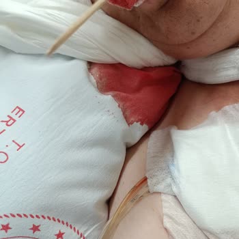 Erzurum Şehir Hastanesi Yoğun Bakımda Yatan Hastanın Bakımı